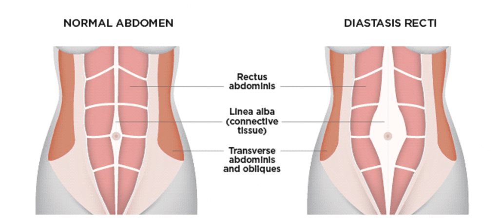 diastasis