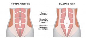 Understanding Diastasis Recti – Part 1 | Hong Kong Sports Clinic