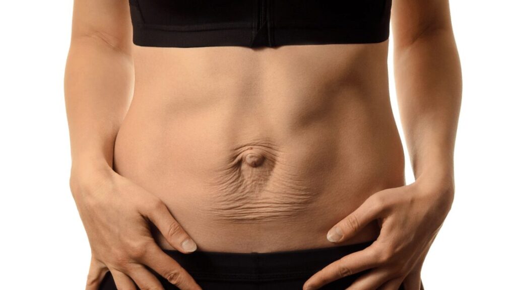 diastasis-recti.
