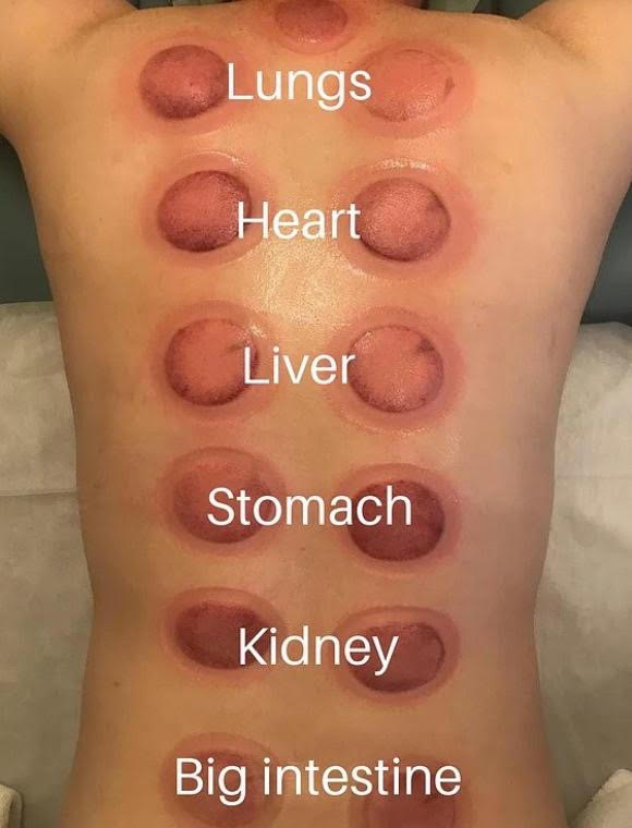 image showing the cupping areas and which organ they help with.