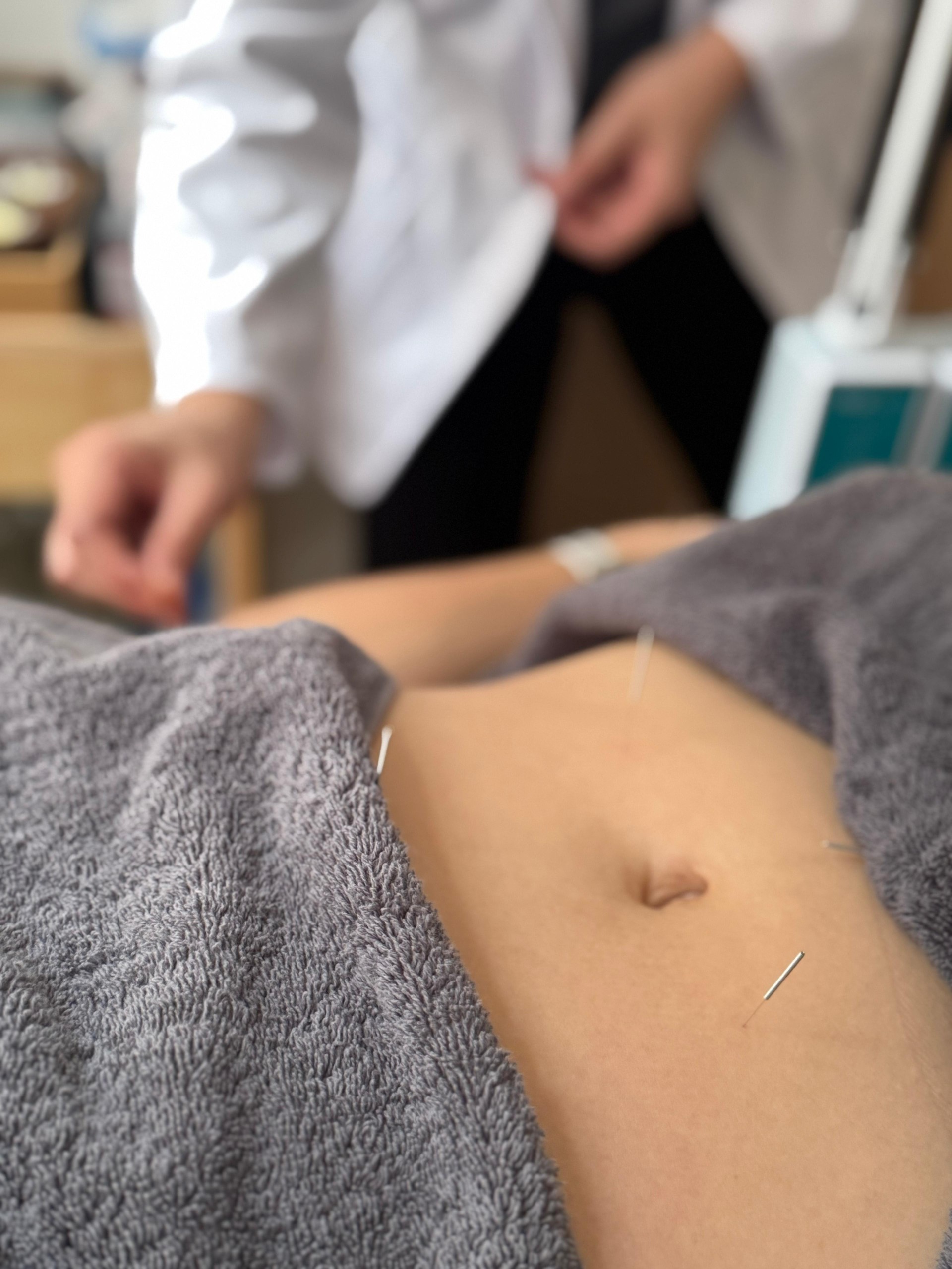 acupuncture needles on the belly of a women preparing for pregnancy.