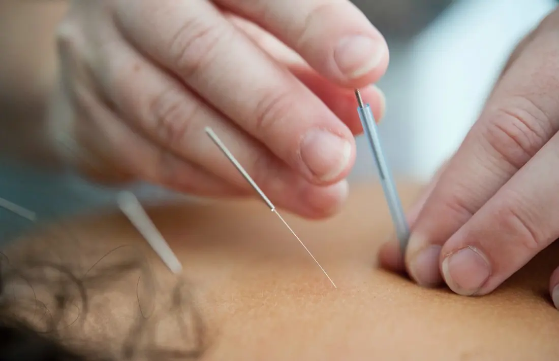 dry needling hong kong